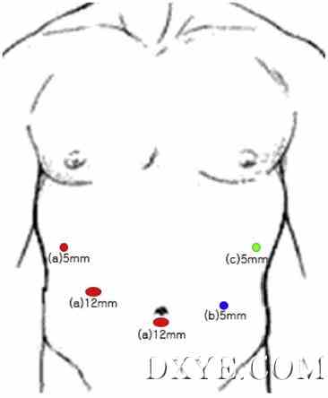 Is the 5-ports approach necessary in laparoscopic gastrectomy- Feasibility of reduced-port totally l ...