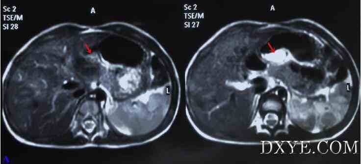 腹腔镜胆囊切除术的2岁男性儿童胆石症和经常性的右季肋部疼痛--病例报告及文献复习