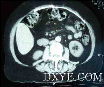 Figure 1. CT image of intra-peritoneal prosthesis.