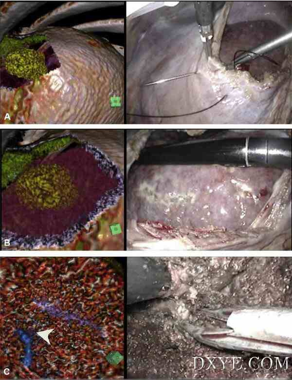 使用 3D 虚拟现实内镜（3DVE）构建虚拟手术环境现已应用于肝切除。
