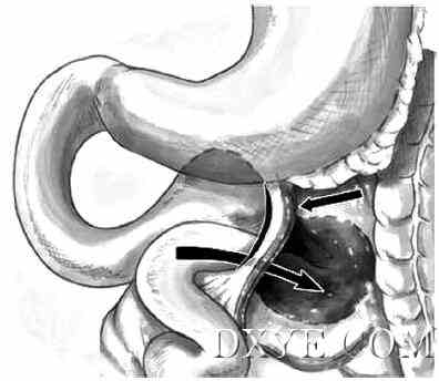 1例急性小肠梗阻左侧十二指肠旁疝的腹腔镜治疗病例报告