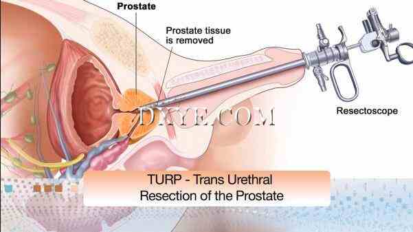 前列腺手术