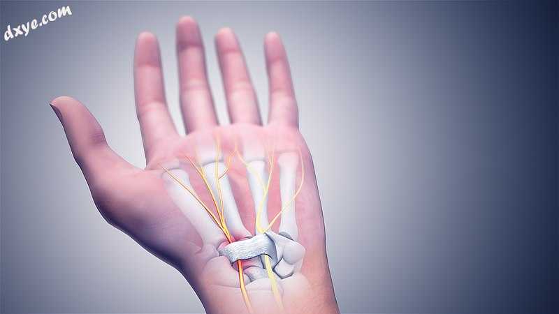 3D medical animation still of Carpal Tunnel Syndrome.jpg