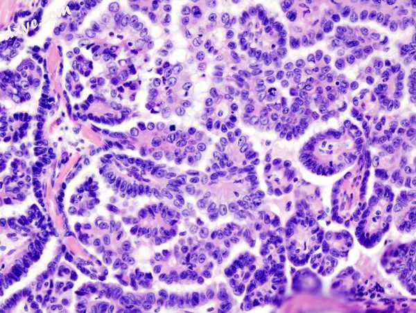 Medium power slide of ovarian serous adenocarcinoma stained using haematoxylin a.jpg