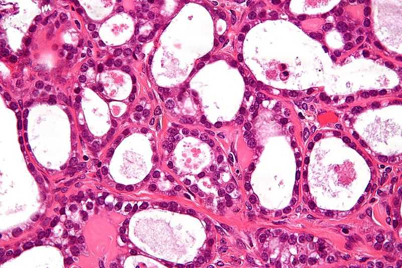 Micrograph of an ovarian clear cell carcinoma. H&amp;E stain..jpg