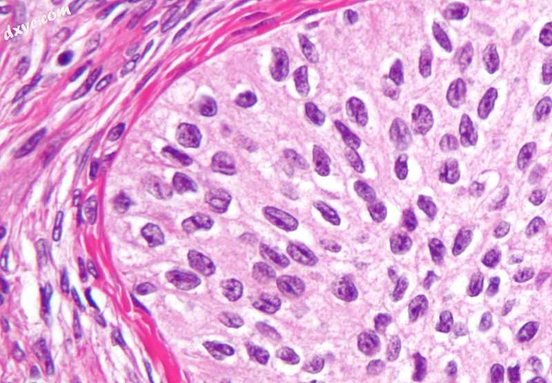 High magnification micrograph of a Brenner tumour showing the characteristic cof.jpg