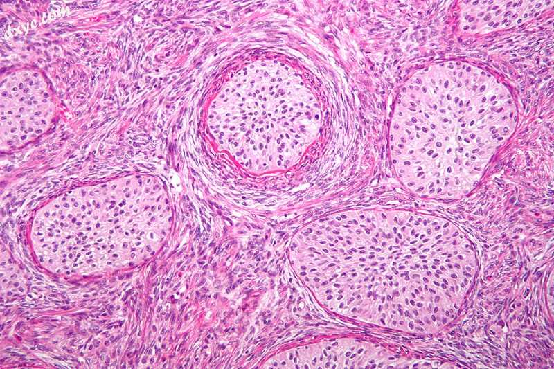 Micrograph of a Brenner tumour. H&amp;E stain..jpg