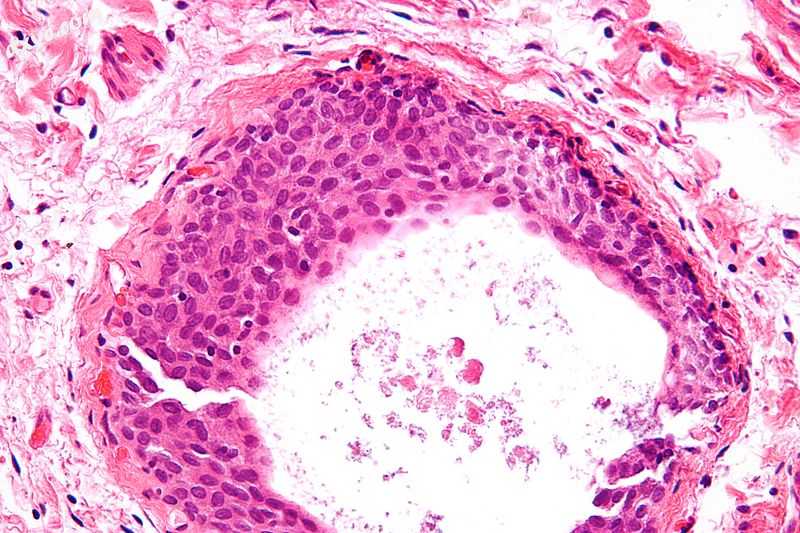 Micrograph of a Walthard cell nest, the entity Brenner tumours are thought to ar.jpg