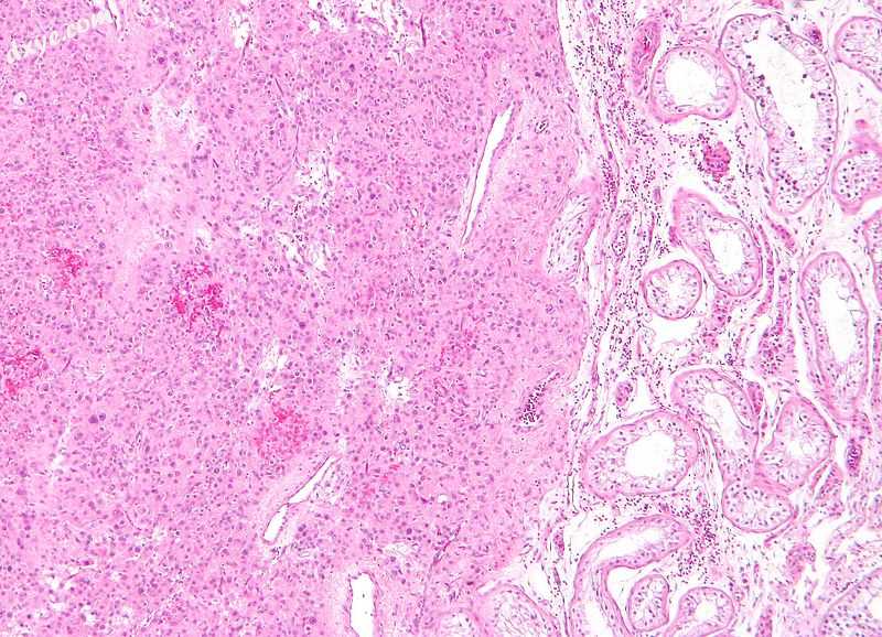 Low magnification micrograph of a Leydig cell tumour. H&amp;E stain..jpg
