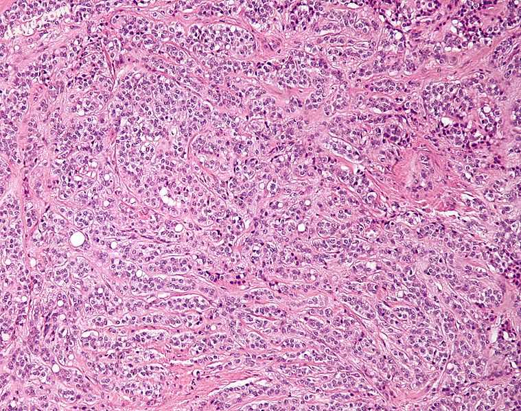Low magnification micrograph of a Sertoli cell tumour. H&amp;E stain..jpg