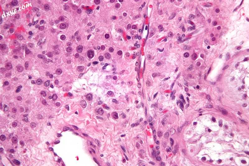 Micrograph of a Leydig cell tumour..jpg