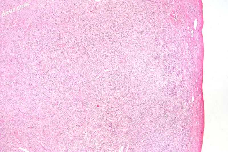 Low magnification micrograph of a 卵泡膜细胞瘤 showing compression of the ovarian cor.jpg