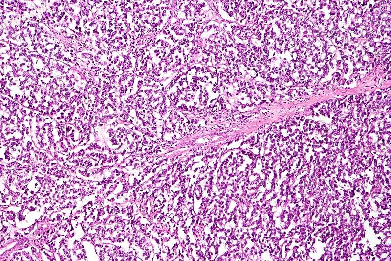 Dysgerminoma characterized by uniform cells separated by fibrous septa with lymp.jpg