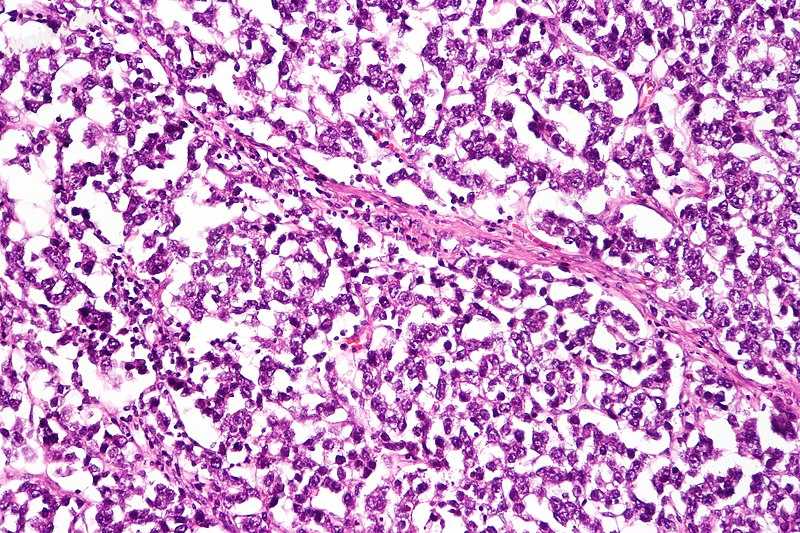 Micrograph of a dysgerminoma, H&amp;E stain..jpg