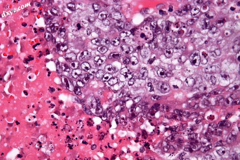Micrograph of an embryonal carcinoma showing its typical features - prominent nu.jpg