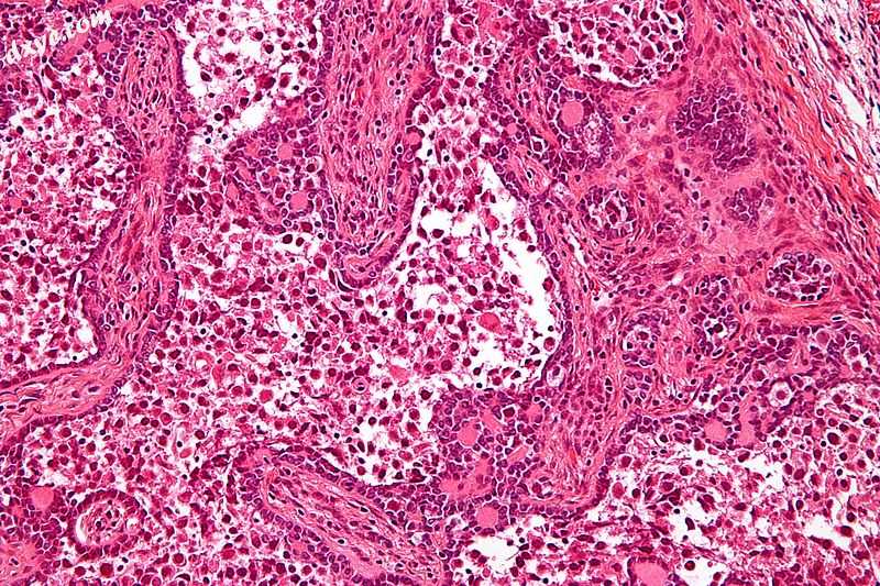 Micrograph of a gonadoblastoma. H&amp;E stain..jpg