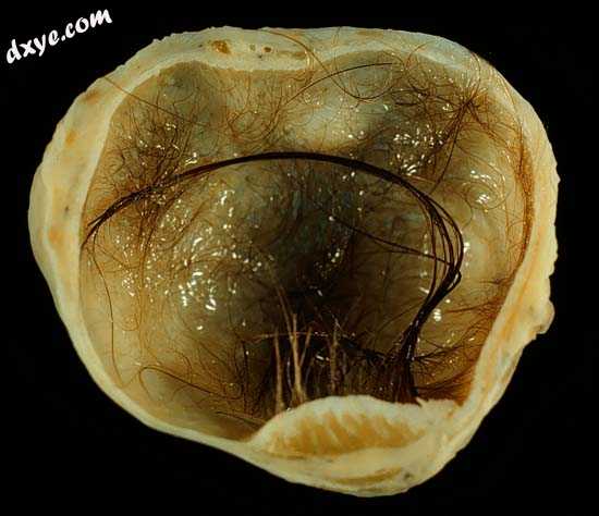 A small (4 cm) dermoid cyst of an 卵巢, discovered during Cesarean section.jpg