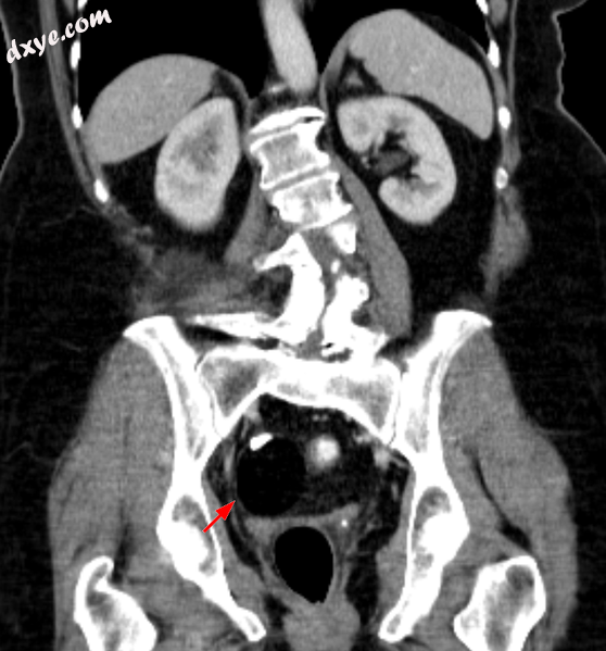 CT showing a teratoma of the 卵巢 fatty formation with a smooth boundary, with .png