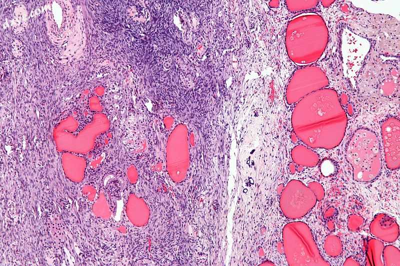 Micrograph of a 卵巢甲状腺肿. Characteristic thyroid follicles are seen on the .jpg