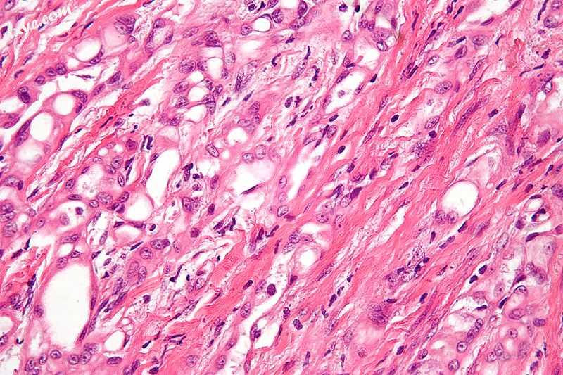 High-magnification micrograph of an adenomatoid tumor. H&amp;E stain..jpg