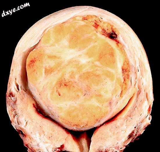 A relatively large submucosal leiomyoma; it fills out the major part of the endo.jpg