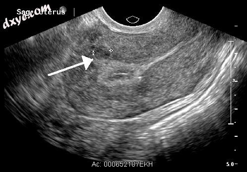 A small uterine fibroid seen within the wall of the myometrium on a cross-sectio.png