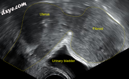 A subserosal uterine fibroid with a diameter of 5 centimeters..png