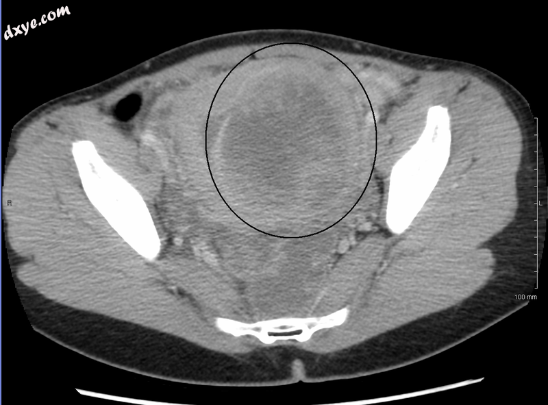 A very large (9 cm) fibroid of the uterus which is causing pelvic congestion syn.png