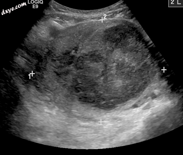 A very large (9 cm) fibroid of the uterus which is causing pelvic congestion syn.png