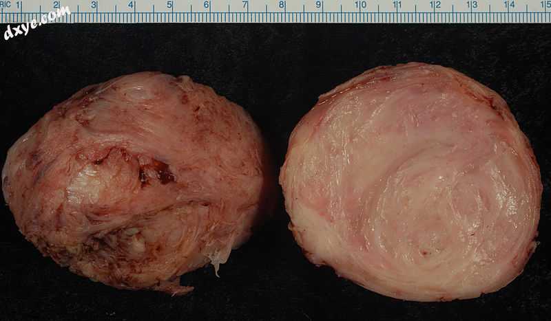 An enucleated uterine leiomyoma – external surface on left, cut surface on right..jpg