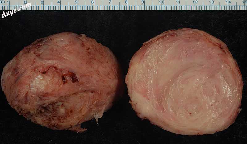 An enucleated uterine leiomyoma – external surface on left, cut surface on right..jpg