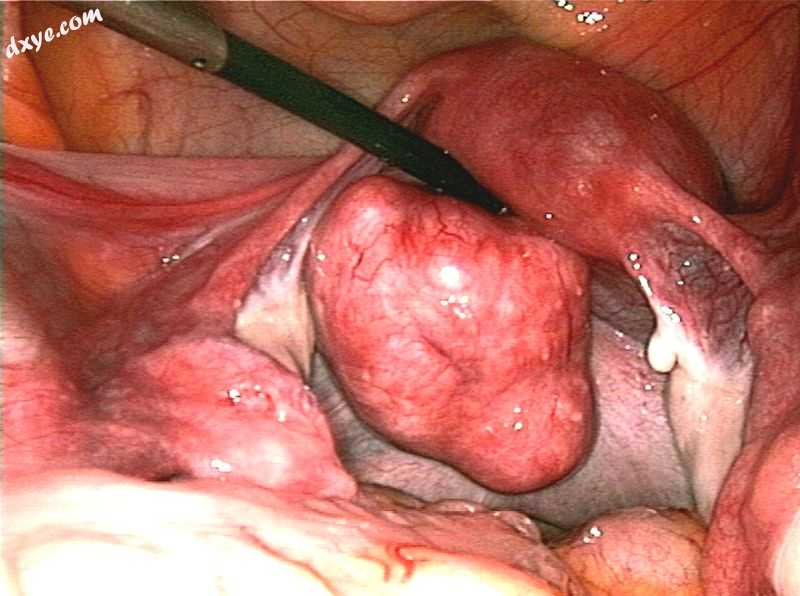 Large subserosal fibroid.jpg