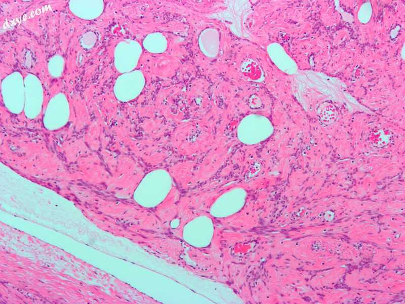 Micrograph of a lipoleiomyoma, a type of leiomyoma. H&amp;E stain..jpg