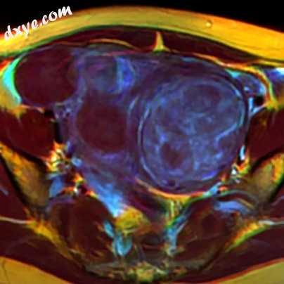 MRI image with multiple uterine leiomiyomas.jpg