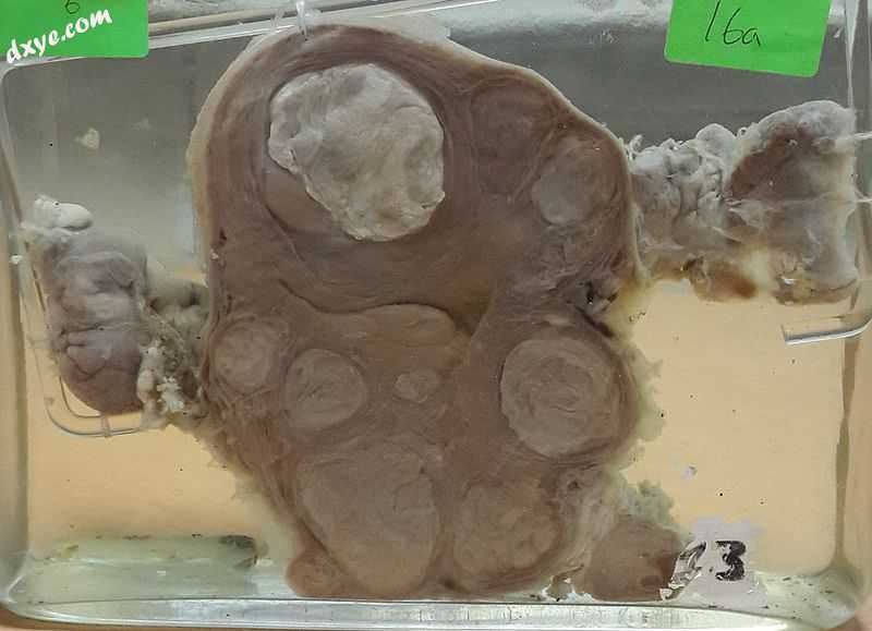 Multiple uterine leiomyoma with calcification.jpg