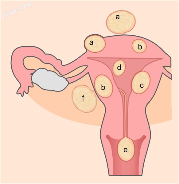 Schematic drawing of various types of uterine fibroids.png