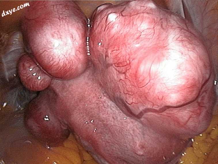 Uterine fibroids as seen during laparoscopic surgery.jpg