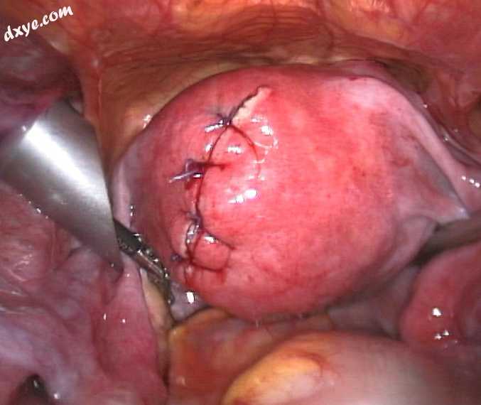 3After treatment of an intramural fibroid by laparoscopic surgery.jpg