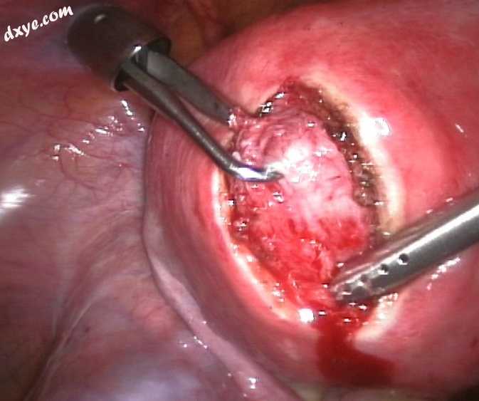 2Treatment of an intramural fibroid by laparoscopic surgery.jpg