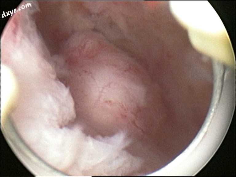 1Submucosal fibroid in hysteroscopy.jpg