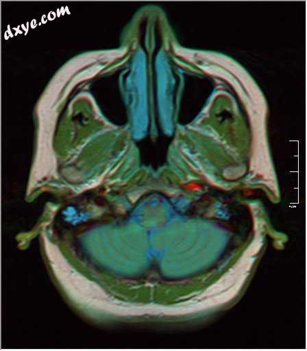 MRI showing fluid in mastoid air cells.jpg