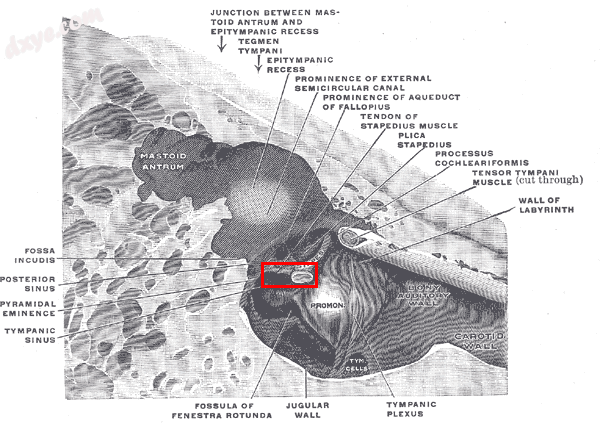 The medial wall and part of the posterior and anterior walls of the right tympan.png