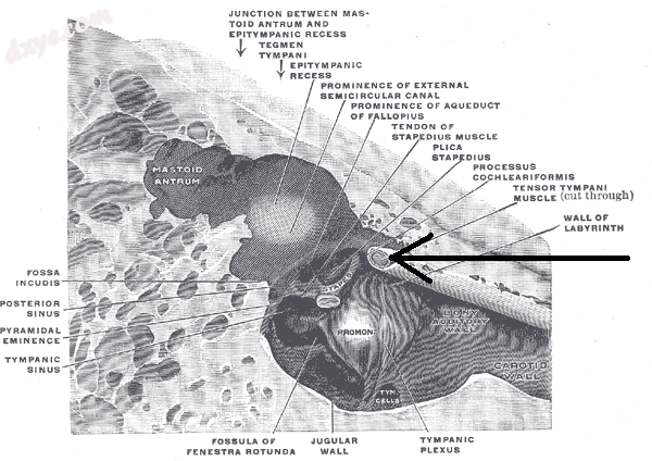 The medial wall and part of the posterior and anterior walls of the right tympanic ca.png