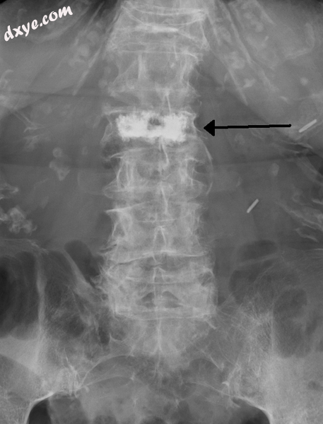 Cement in a vertebra as seen on plain Xray..png