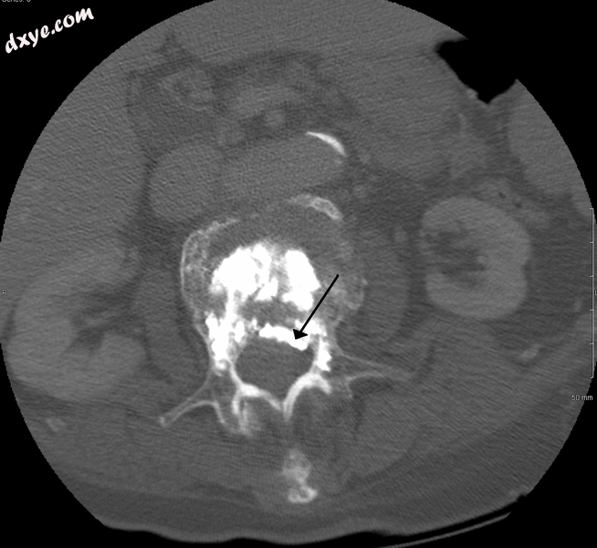 A CT image of cement used in kyphoplasty that has entered the spinal channel and.png