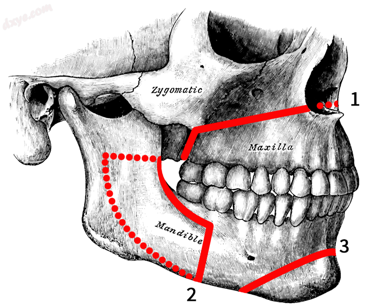 Osteotomies of the jaws 1. Lefort I 2. Sagittal split 3. Genioplasty.png