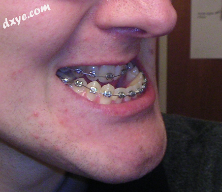 Patient exhibits a mandible prognathism. Requires a mandible osteotomy to correct..png