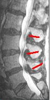 MRI of the lumbar spine showing spinal stenosis.jpg