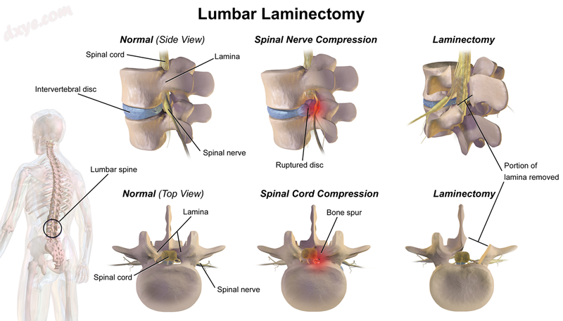 Lumbar 椎板切开术..png