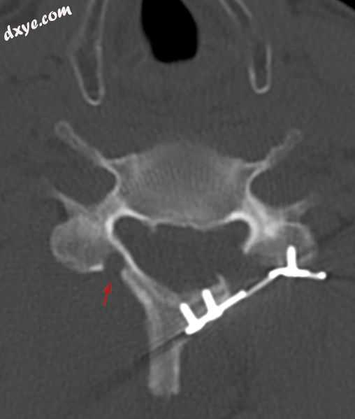 CT scan of Laminoplasty of cervical vertebra.jpg